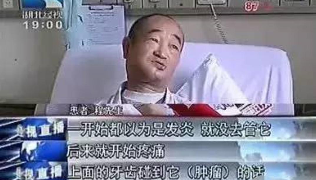 蛀牙不治疗烂掉了会不会得口腔癌,蛀牙长期不治疗会得牙癌吗