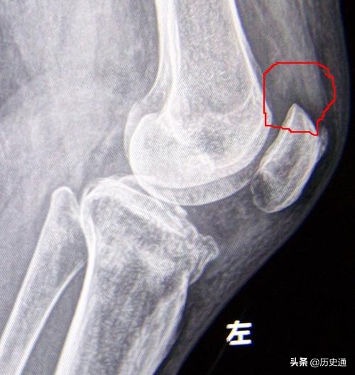 中医正骨传人与西医骨科医院的一场切磋，孰胜孰败，一目了然