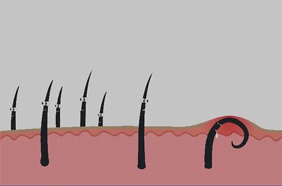 屁屁上有毛球怎么回事,臀部长毛的原因是激素分泌旺盛吗