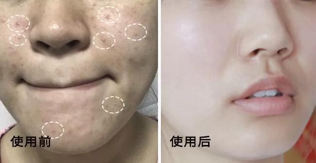 专治螨虫的洗面奶,螨虫专用洁面乳