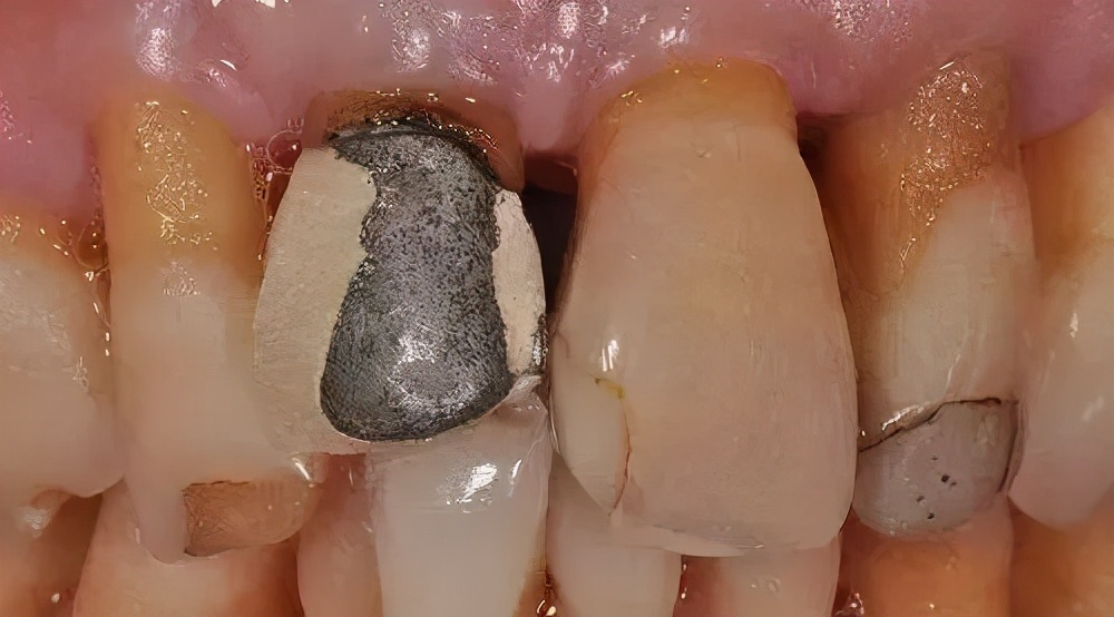 烤瓷牙基底冠如何清洁不崩瓷,烤瓷牙咬合面崩瓷必须重做吗