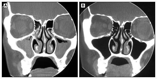 鼻窦炎解释,疑似鼻窦炎是鼻窦炎吗