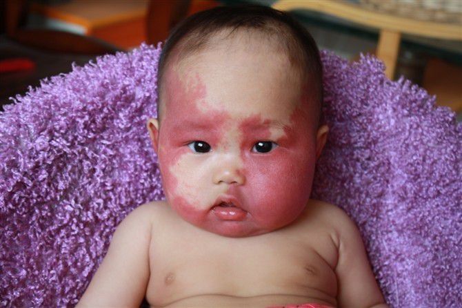 胎记该不该消除,胎记前世是什么意思