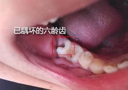 六龄齿龋坏修复全过程,六龄齿龋坏了怎么办