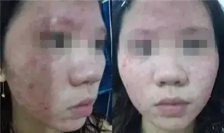 过敏的化妆品怎样处理,过敏性皮炎化妆品过敏怎么办