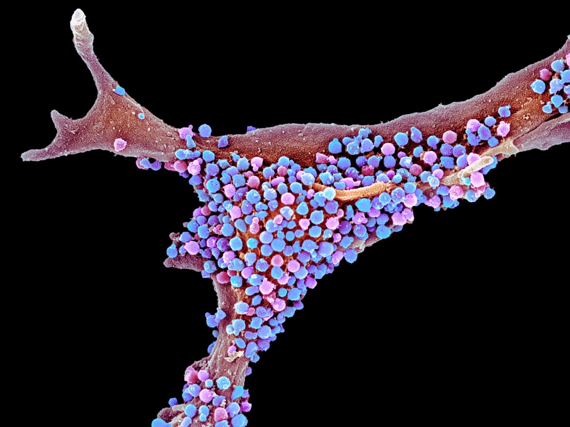 阿尔茨海默症淀粉样蛋白能降解吗,淀粉和阿尔茨海默病的关系