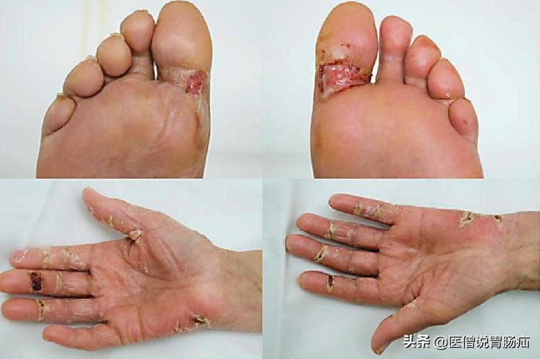 吃卡培他滨药要注意什么,卡培他滨片不良反应持续多久