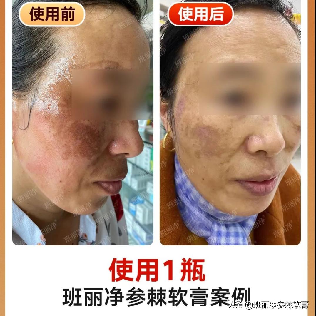 现在很多人都在祛斑靠谱吗,到底祛斑是真的还是假的