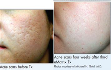 不同痘坑凹洞擦什么药膏,不同痘坑怎么修复