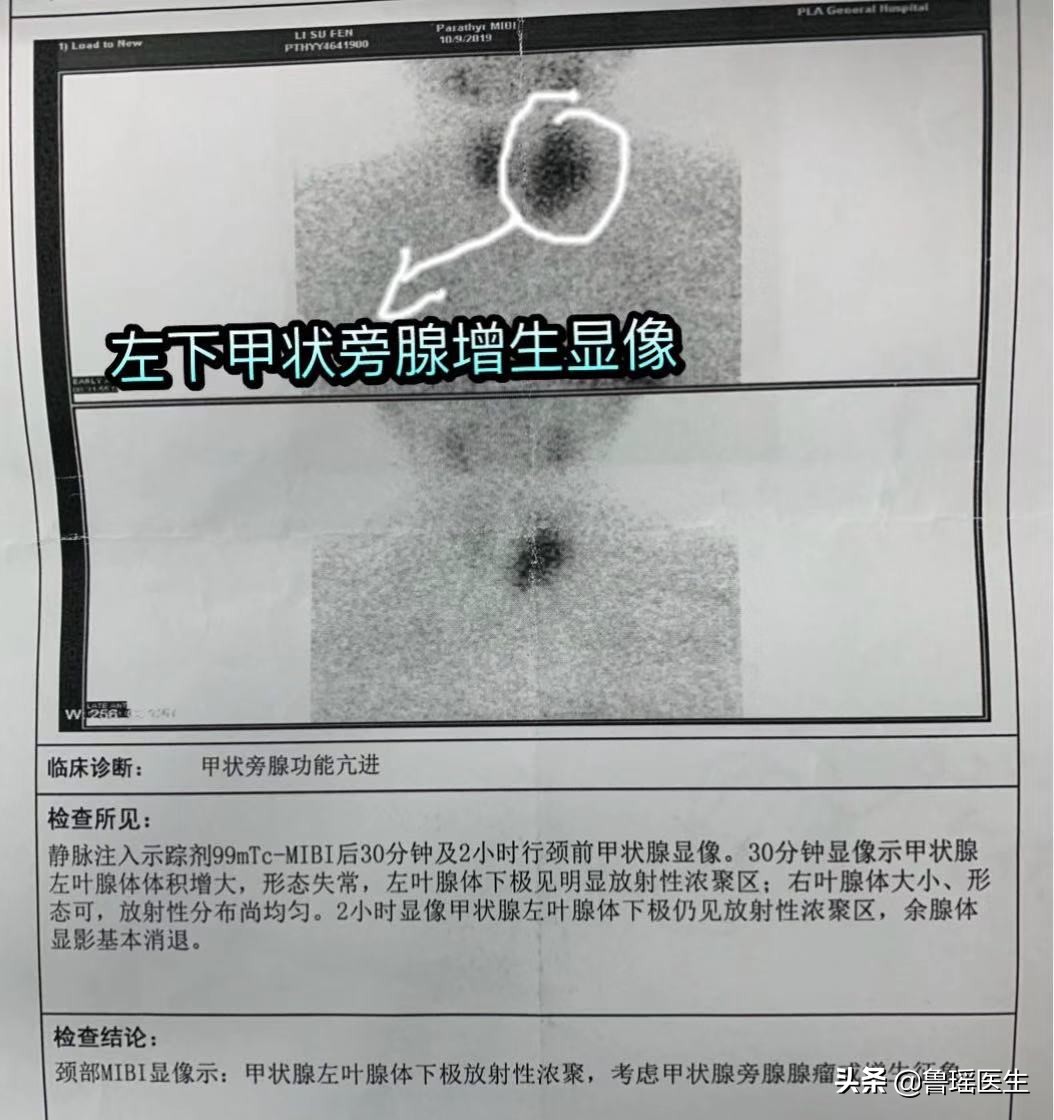 尿道结石会导致腹胀消化不良吗,关节炎和尿路结石是什么代谢异常