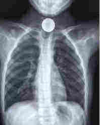 误吃硬币应怎么处理,小孩误吃硬币了怎么办