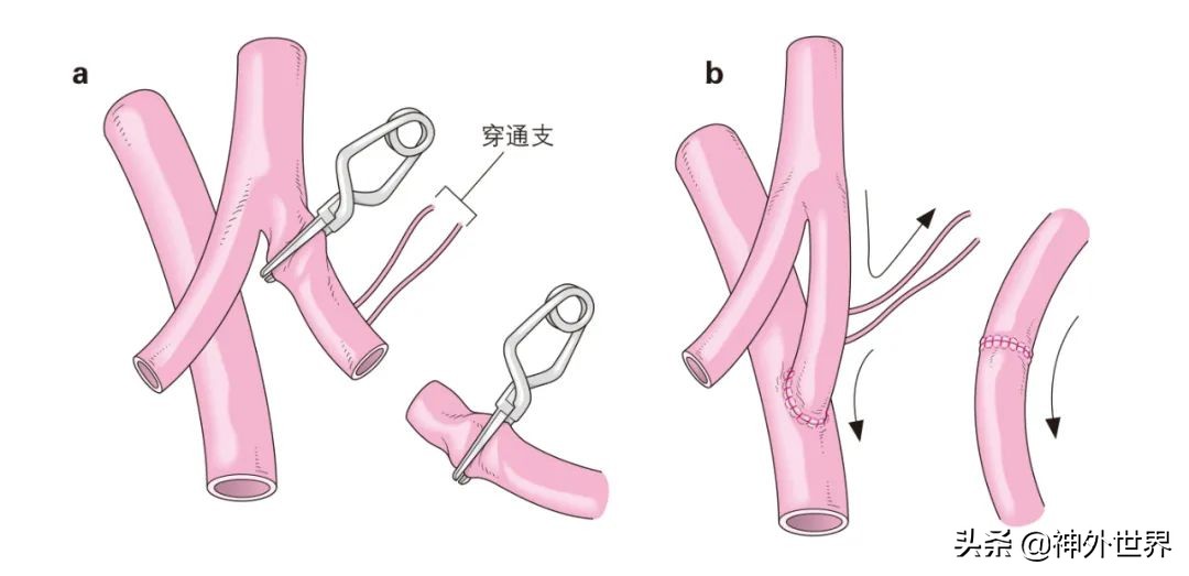 日本治神经损伤特效药,脑动脉炎症状与治疗