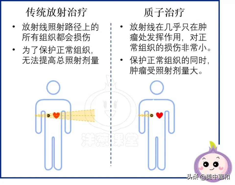 质子放疗治疗肿瘤,肿瘤放射治疗用什么射线