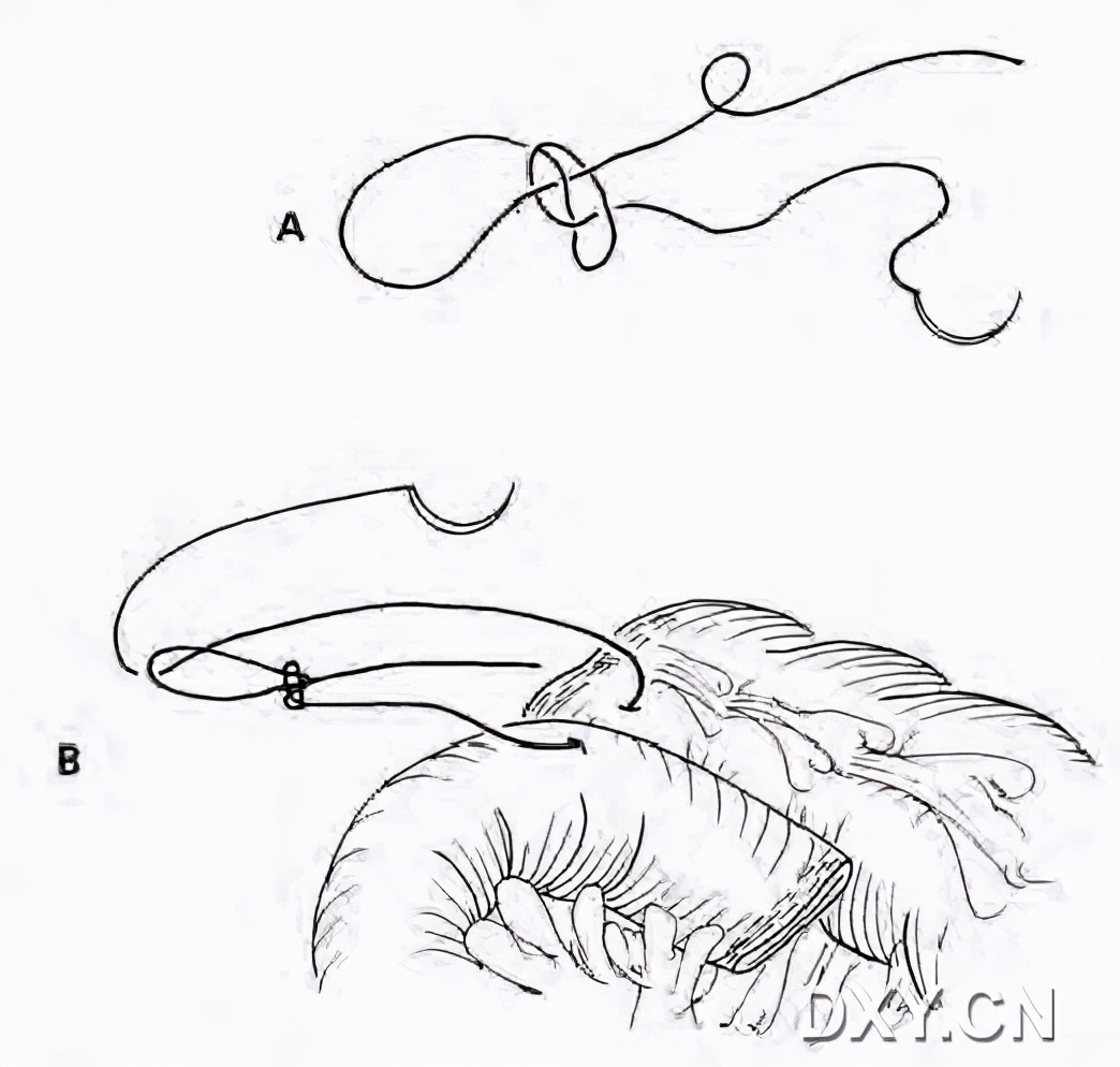 腹腔镜下切割缝合器使用视频,腹腔镜下缝合教程