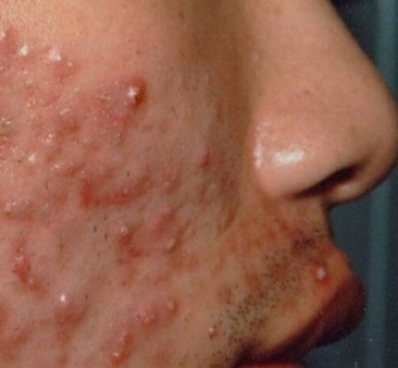 各种痘痘的形成应该如何快速根治,痘痘是怎么形成的原因及解决方法