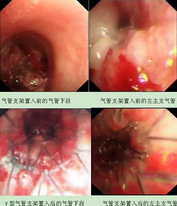 提醒｜烟龄40年肺鳞癌“找上门”，支气管镜下多种手段通畅气道