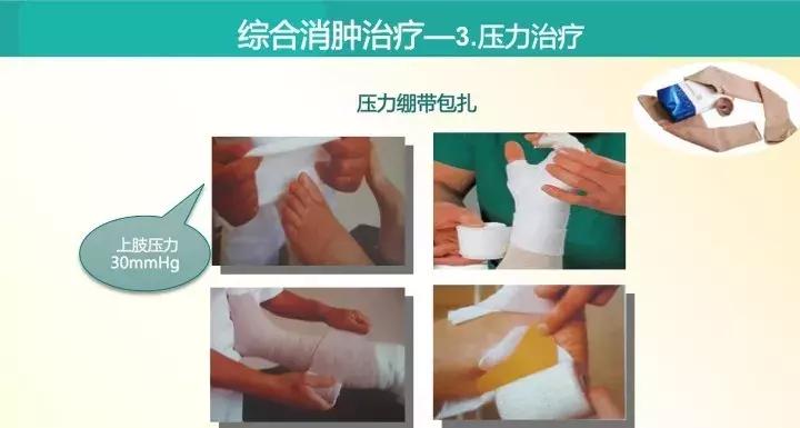 乳腺癌放疗水肿怎样解决,乳腺癌放疗后出现水肿怎么办