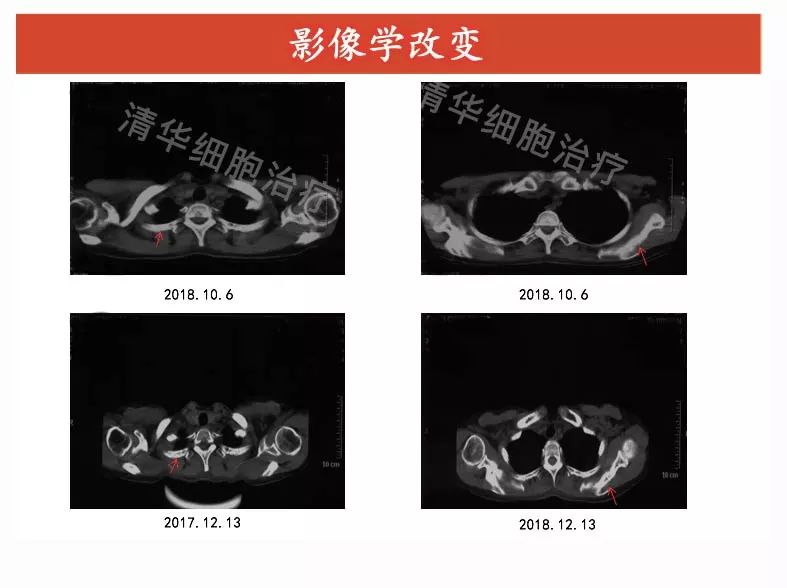 卵巢癌术后需要几次化疗,卵巢癌先化疗三次再手术效果好吗