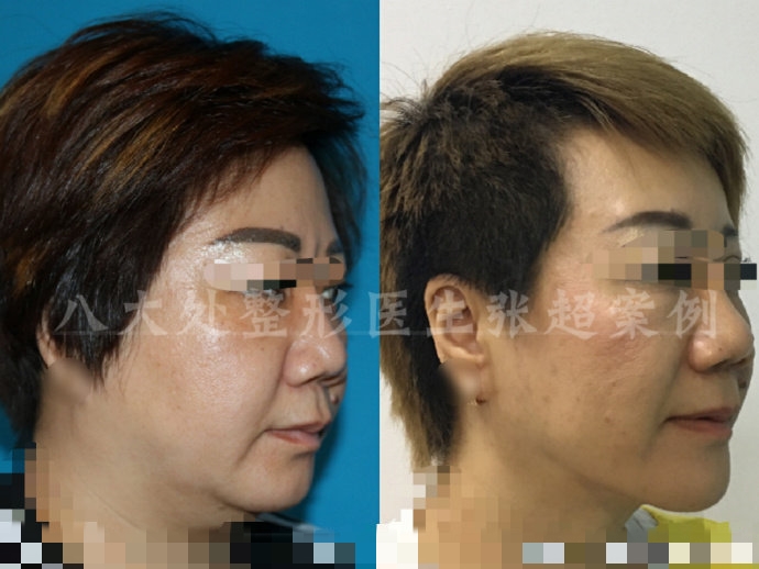 八大处整形张超,八大处张超最新视频