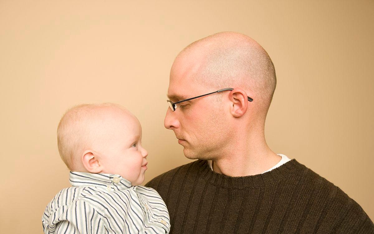 脱发和头发长有关系,脱发导致发际线一直往后拖