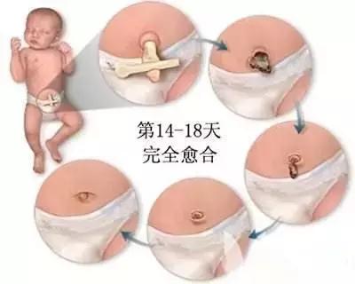 新生儿脐带一个月还没脱落正常吗,新生儿脐带一个月还没掉正常吗
