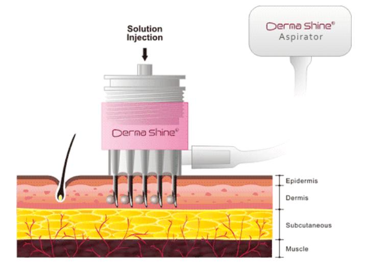 水光针的秘密这些美容针剂要当心,现在流行的水光针美容靠谱吗