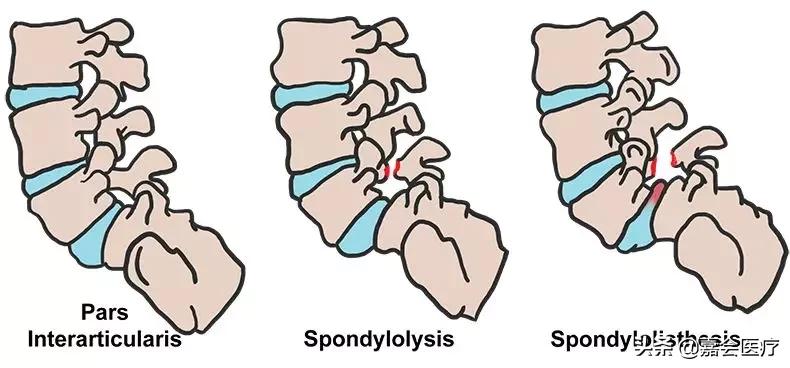 腰椎椎弓崩裂是什么原因造成的,腰痛是犯了什么因果