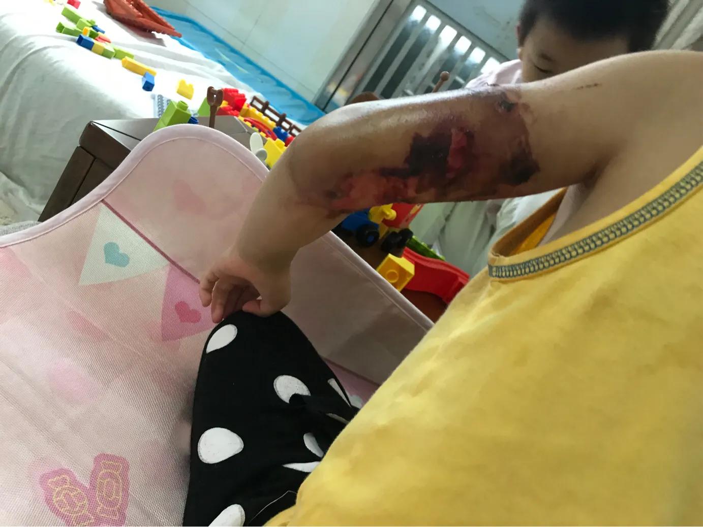 当女儿被严重烫伤疼痛难忍,幼儿园女孩被烫伤治疗过程