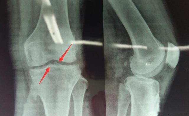 膝盖骨刺疼的最好治疗方法,膝盖骨刺疼痛怎么康复治疗