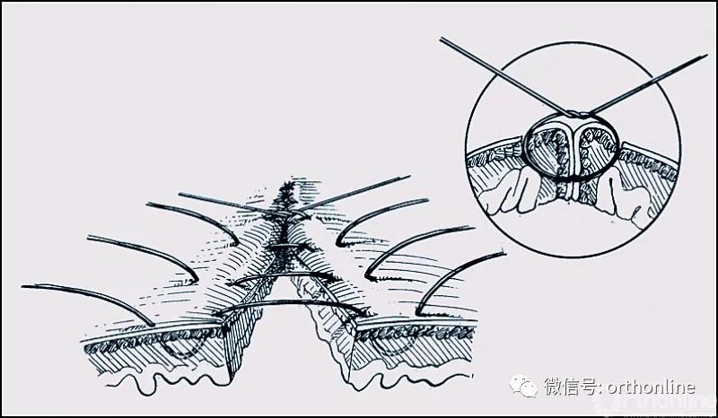 十种外科基本缝合方式详解,手术切口缝合有哪几种