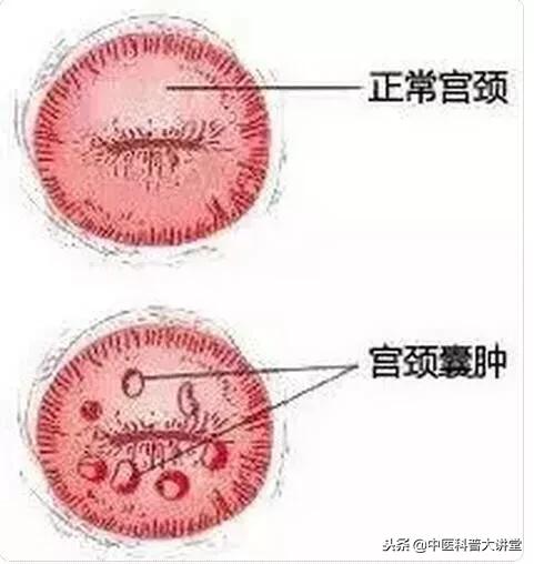 宫颈有青春痘是什么原因,宫颈纳氏囊肿就像青春痘