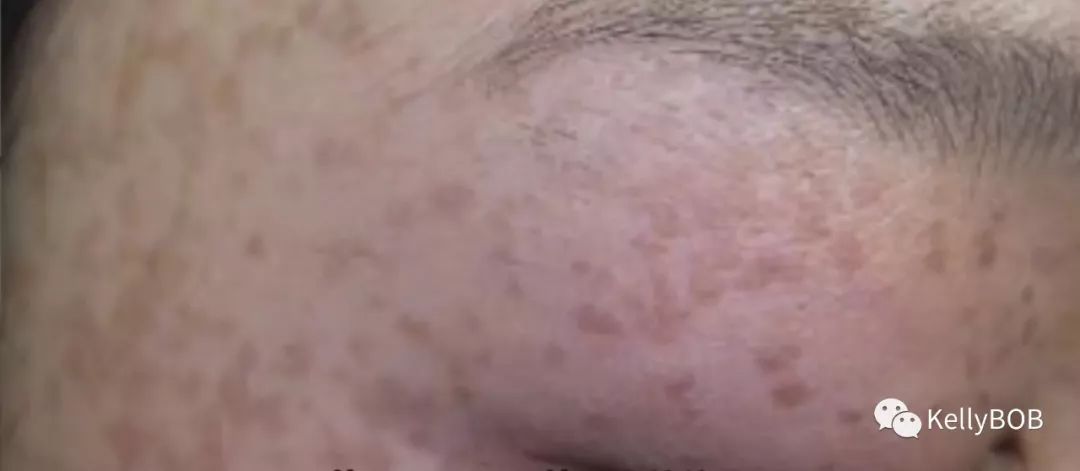 告别脂肪粒秘籍,去眼部脂肪粒最有效的方法