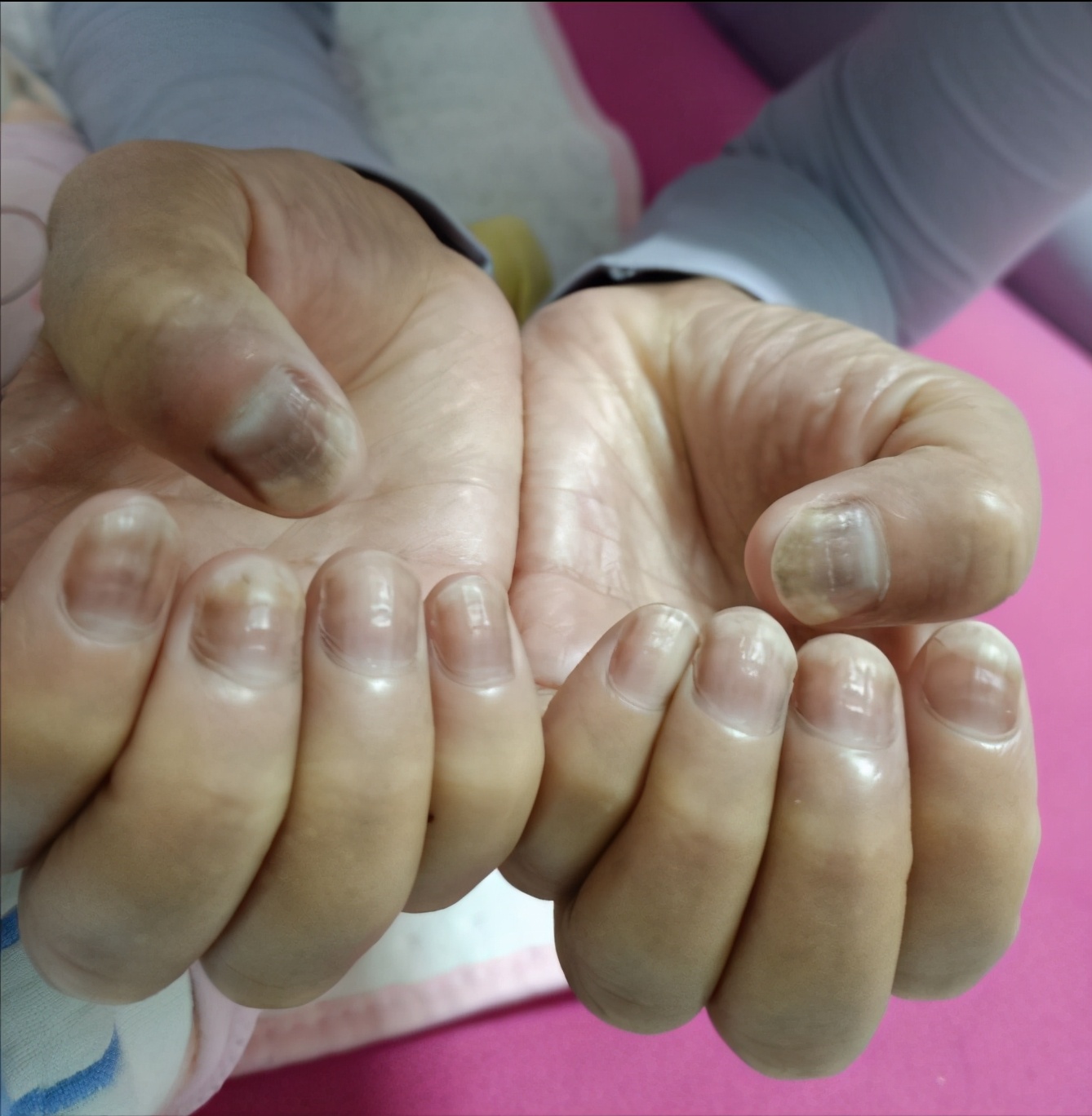 晚期三阴乳腺癌的治疗方案,三阴浸润性乳腺癌100%的复发吗