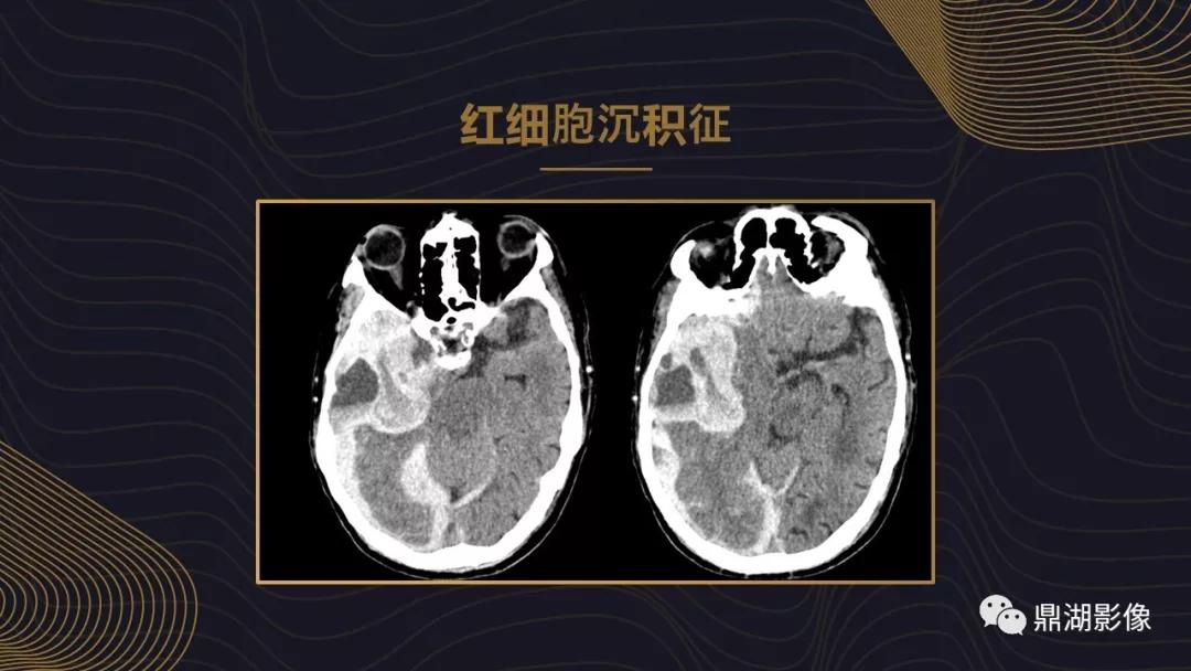 不简单|脑出血超详细学习笔记
