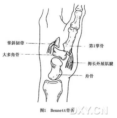 特殊骨折类型,特殊骨折体征