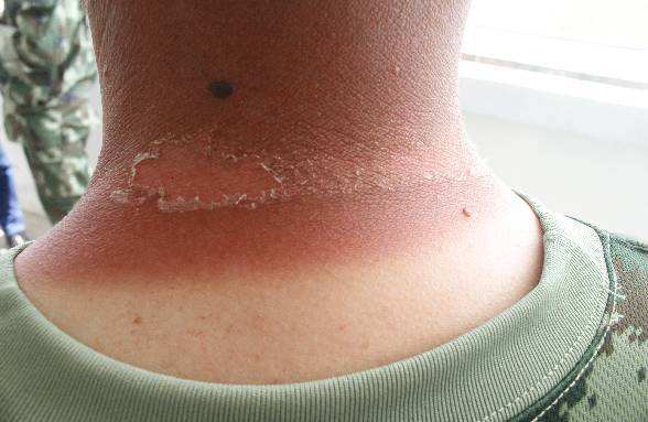 晒伤了发红发烫怎么快速修复变白,太阳晒伤是怎样的