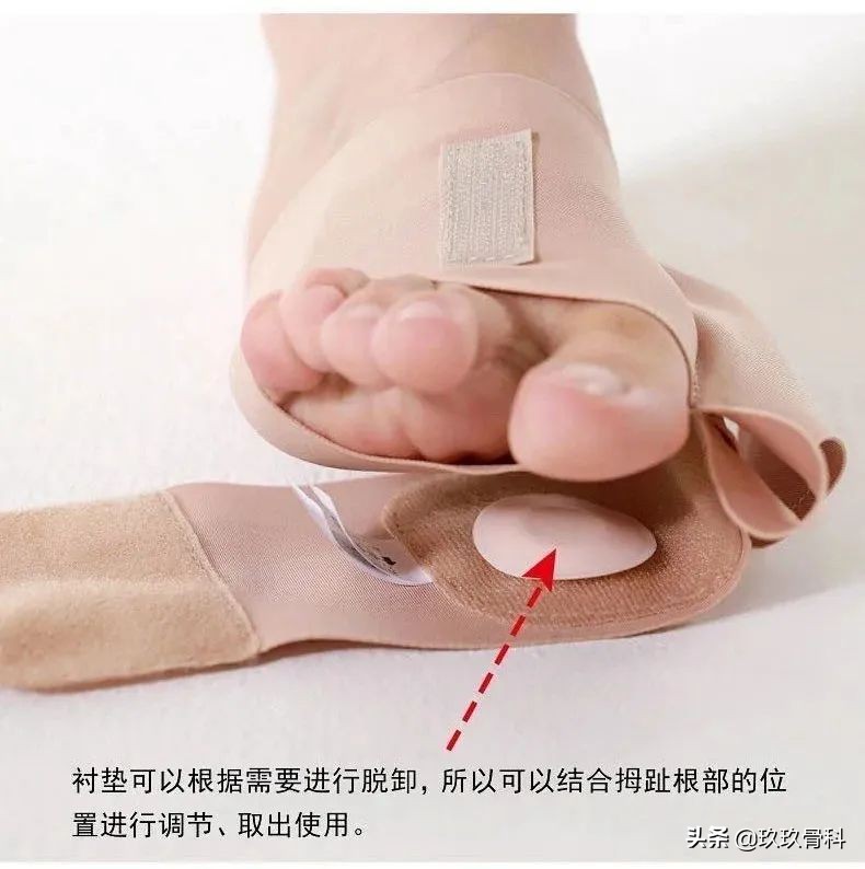 拇外翻的女人命真的苦吗,困扰女性的拇外翻