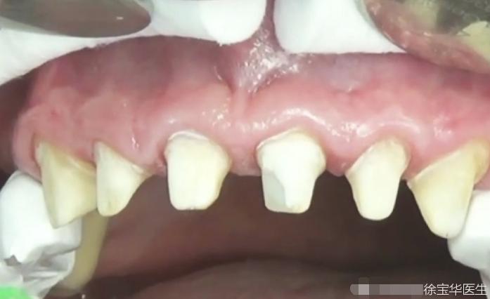 烤瓷牙贴片全口价格,贴片牙齿和烤瓷牙有哪些伤害