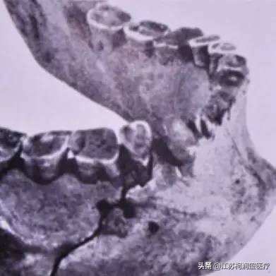 一篇文章带您走过种植体的前世今生