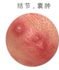 痘痘中医怎么解释,痘痘中医