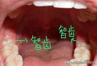 普及一下拔智齿全过程,拔智齿预警看完你再决定要不要拔