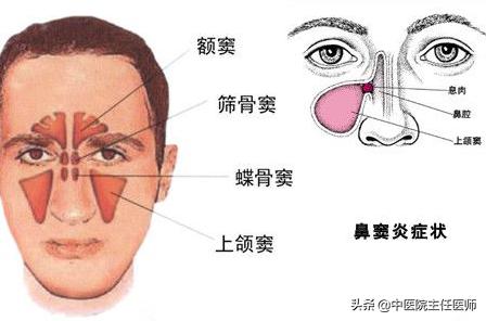 鼻窦炎危害有哪些,鼻窦炎有哪些危害