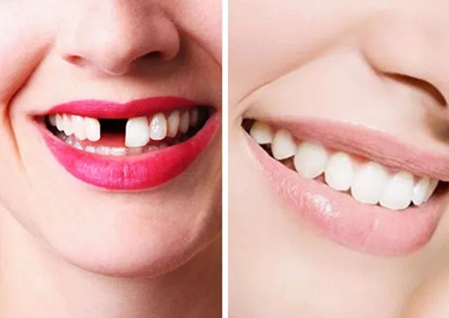 30岁种牙好还是镶牙好,我30岁了到底该不该整牙