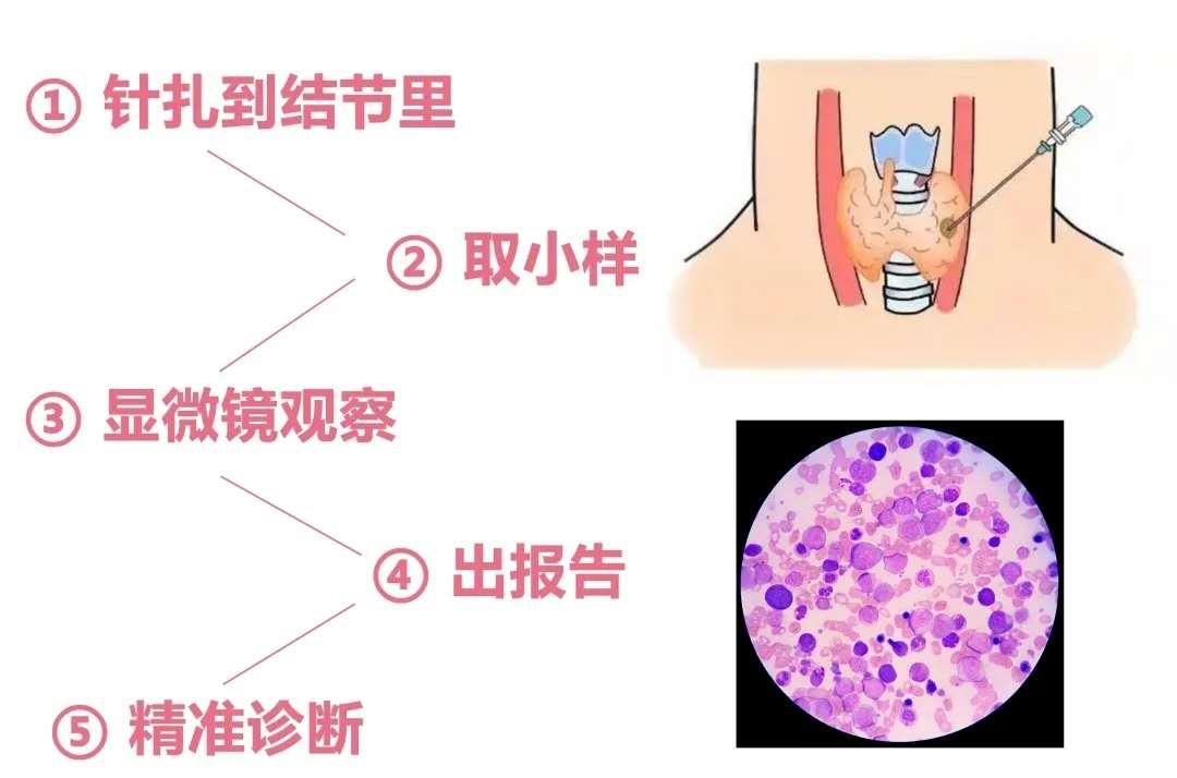 为什么肿瘤患者都拒绝做穿刺活检,穿刺活检恶性还能手术吗