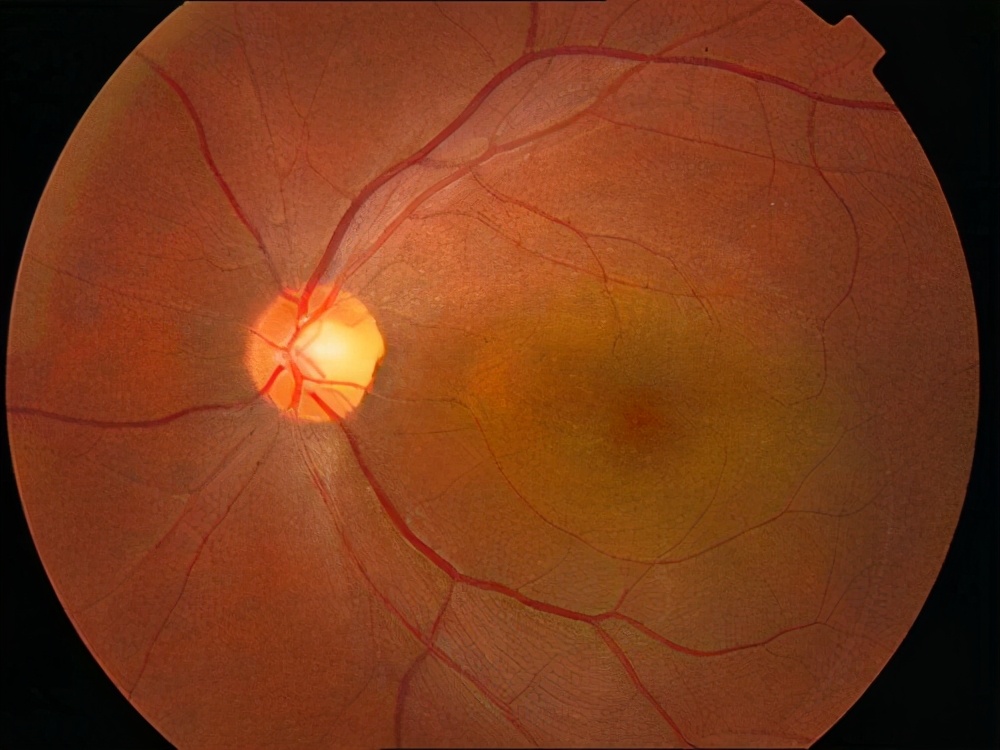 黄斑视网膜病变,黄斑病变会导致夜间视力下降