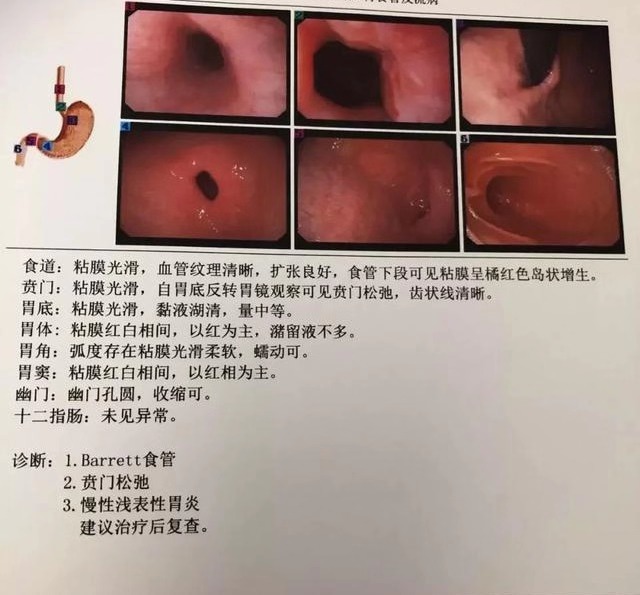 口苦口臭伴恶心反酸，奔走治疗好多年，最后病根发现毛病竟在胃