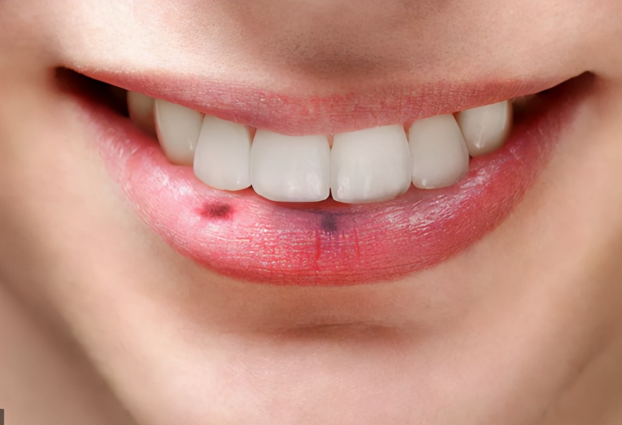 嘴唇有黑痣一定肠道息肉吗,嘴唇上长黑斑与肠息肉