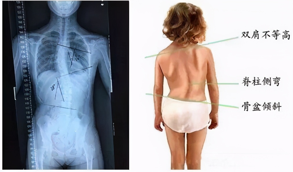 长期侧睡的危害有哪些,左卧睡姿的危害