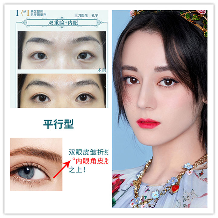 为什么有人割了双眼皮反而不好看,为啥有些人割了双眼皮变化巨大