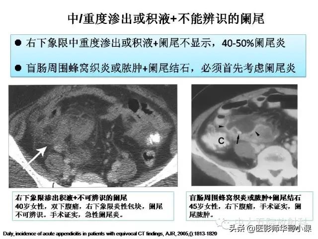 阑尾炎课件,阑尾炎的超声课件